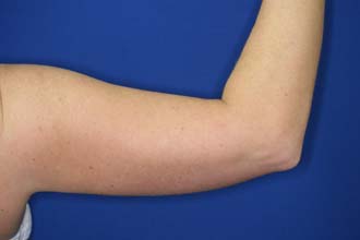 Upper Arms Liposuction Images From KM Surgical   .aspx